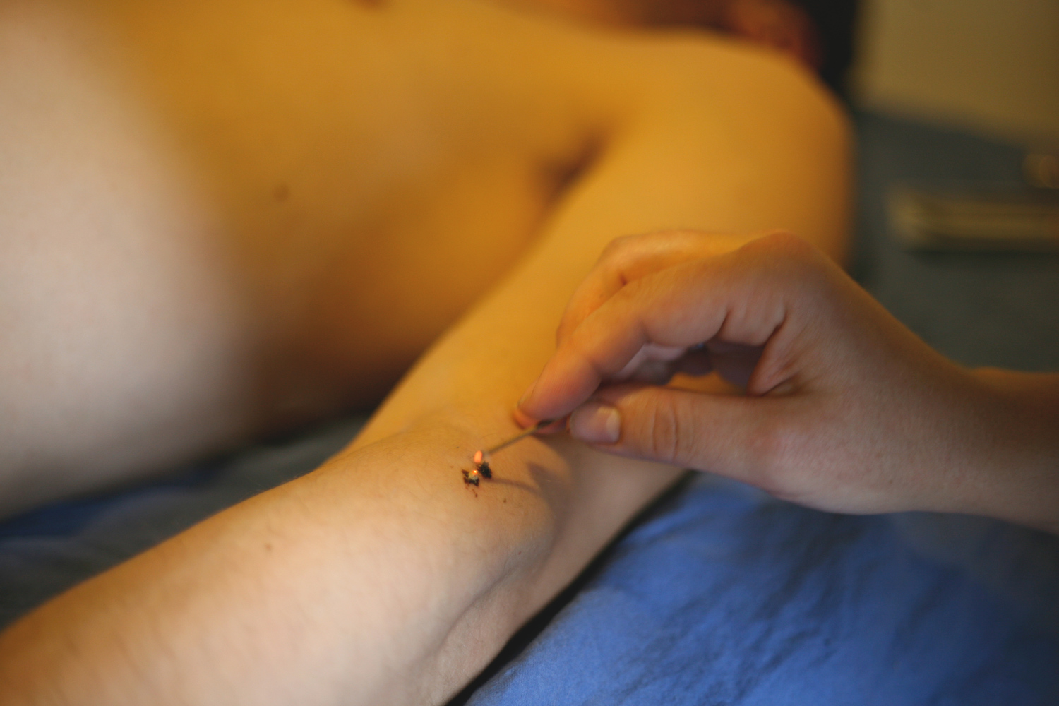 A Vivacity Acupuncture photograph showing Margie Navarro LAc lighting a moxa cone on a Kiiko Matsumoto style acupuncture point used for immune therapy on a patient's left forearm.