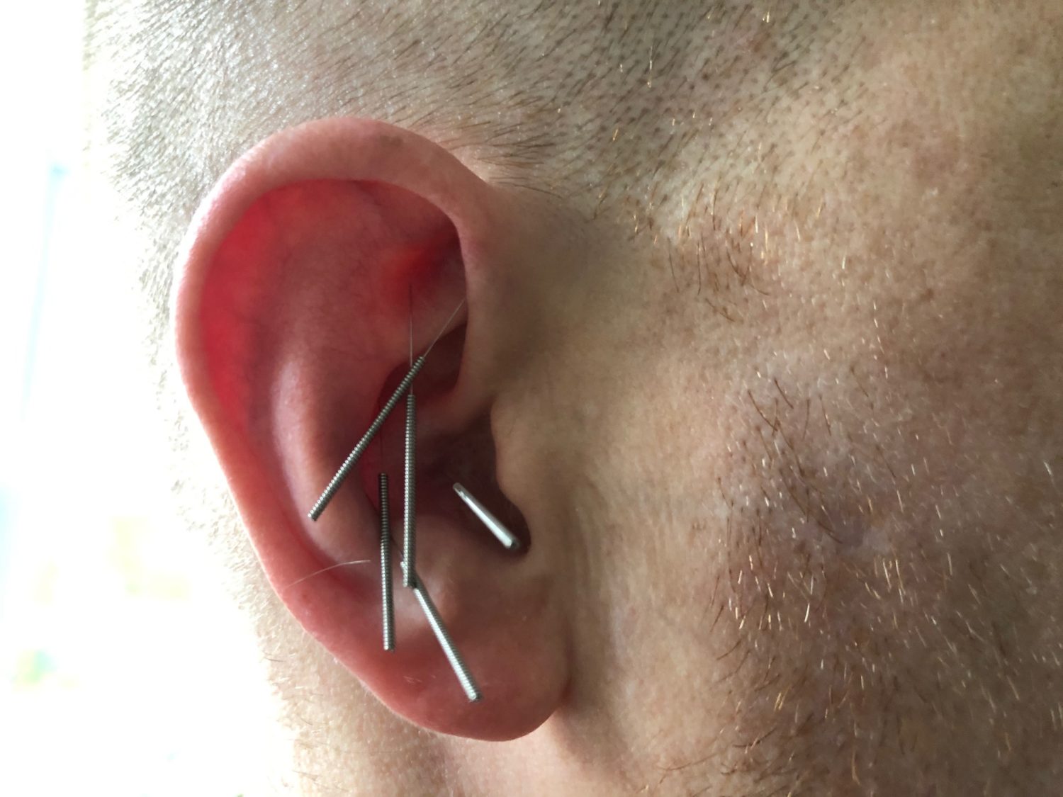 A Vivacity Acupuncture photograph showing five auricular acupuncture needles inserted at points on the patient's right ear. These points are known as the 5-point protocol developed by Dr. Mutulu Shakur.