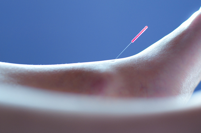 A photograph showing an acupuncture needle inserted on the lower left leg of a patient.