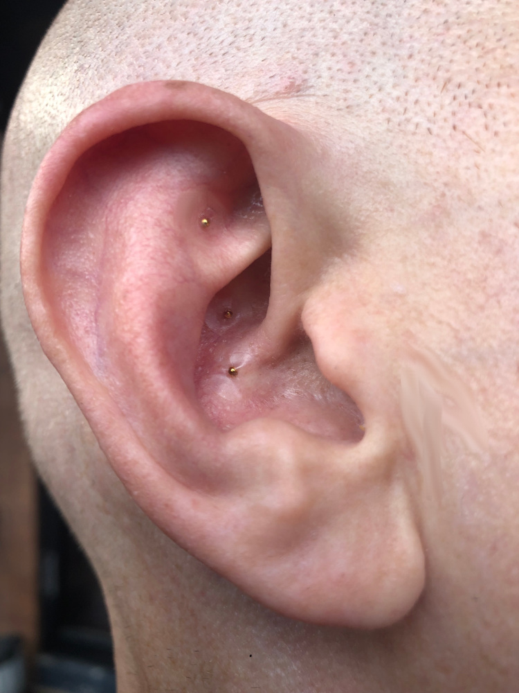 Acupressure 'ear seeds' applied at Vivacity Healthcare.